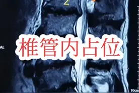 椎管内占位的核磁表现 #神经鞘瘤 #椎管内占位 #脊髓损伤 #腰椎管狭窄 #腰腿痛
