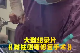 这一下就把我弯腰驼背的病给治好了啊！#骨科 #脊柱侧弯 #手术视频封面