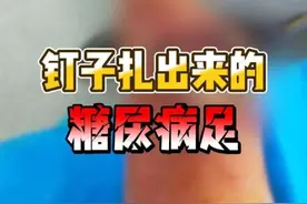 钉子扎出来的糖尿病足#糖尿病足 #糖尿病并发症 #糖尿病足溃疡 #