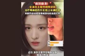 “痒到崩溃！”女演员#王楚然 晒照求助治疗#荨麻疹 的方法，脸上长满红疹，称剧烈#运动 或是#情绪激动 就会起红疹