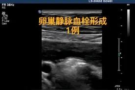 卵巢静脉血栓超声表现。#超声影像 #超声学习 #医学科普 #医学小知识 #超声医学 @抖音短视频视频封面