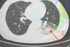 据红星新闻5月8日报道，成都一男子吹空调致白肺，专家提醒警惕军团菌肺炎。视频封面