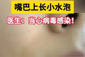 嘴唇上起小水泡，30s医生教你如何快速消除 #单纯疱疹#上火#烂嘴角#病毒#抖出健康知识宝藏视频封面