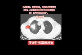 #毛霉菌 #气管镜检查 #艾沙康唑 #如有不适请及时线下就医 #两性霉素b  糖尿病患者警惕肺毛霉菌感染！ 糖尿病患者因高血糖削弱免疫力，易感染肺毛霉菌，致死率高。案例中中年男性患者出现咳嗽、发热后及时就诊，确诊后采用全身抗真菌药物（如艾沙康唑）联合多次气管镜下局部灌药及清创治疗，最终康复。该病进展迅猛，早期诊断（影像学+气管镜取样）是关键，延误易致呼吸衰竭。治疗需“双管齐下”：全身用药抑制真菌扩散，气管镜精准清除病灶，显著提高治愈率。糖友出现呼吸道症状务必尽早就医，并严格控糖，为抗感染保驾护航！视频封面