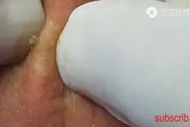 一个萝卜一个坑#消除鼻头粉刺的正确有效方法 #痘痘黑头粉刺拜拜