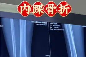 踝关节骨折:Lauge-Hansen分型旋前外展1°，但1度损伤有时候和旋前外旋1°很相似，这时需关注下胫腓联合处是否有压痛，所以触诊永远是医生最基本的诊断手段，其次内踝横断形骨折有时候会有软组织卡压，这个是导致内踝不愈合或者延迟愈合的重要因素。视频封面