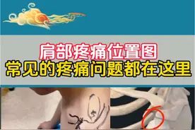 肩部疼痛位置图 肩部疼痛位置图，常见的疼痛都在这里！你属于哪个位置疼？#医疗创作者培优计划 #肩部疼痛位置图详解 #三伏天养生 #硬核健康科普行动 #肩袖损伤