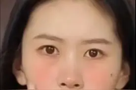 #dou来说健康 #肋骨外翻与正常对比图  #严重影响学习和工作的患者可以关注手术#脸红 #赤面症 #赤面恐惧症视频封面