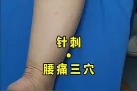 针刺，腰痛三穴。委中、承山、昆仑。 #扎针#门诊日常#抖出健康知识宝藏#腰痛 #针灸学习