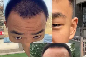 还有什么植发的问题可以尽管问#植发 #内容过于真实 #蜕变过程 #植发后的真实记录 #内容过于真实