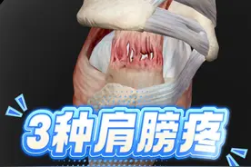 肩周炎、肩袖损伤、Slap损伤到底是怎么回事？ #抖音创作季 #肩周炎 #肩袖损伤 #slap损伤 #抖出健康知识宝藏视频封面