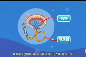 【膀胱腔内灌注化疗】 腔内化疗，精准杀癌，膀胱灌注，您了解吗？ 免责声明：内容仅用来科普参考使用，部分数据来源网络，不能确定其准确性，文章中所有文字和描述均不能作为用药指导，如需看病用药，请去正规医院就诊。所转载的文章、图文、视频版权和文责属原作者所有，若您是原作者且不希望文章被转载，请联系我们删除。#医学科普 #科普 #科普一下 #生命科学 #知识科普视频封面