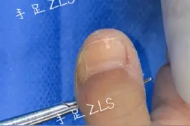 复拇指 诊断：复拇指。治疗：多指切除，甲襞成形。#复拇指 #拇指多指 #多指 #张立山手足畸形矫形