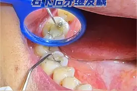 右下后牙继发龋，过去补的光敏树脂材料掉了，重新去腐充填 #继发龋 #银汞合金补牙 #光敏树脂 #补牙材料 #口腔医生赵晶 @DOU+小助手 @抖音医疗健康小助手 @健康中国 @健康北京视频封面