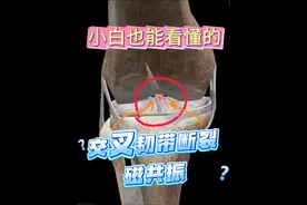 膝关节扭伤，别大意！交叉韧带可能断裂 #膝关节扭伤 #交叉韧带视频封面