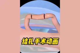 结扎手术，过程以及注意事项，3D动画科普！#dou上热门
