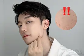 痘坑，没在怕的！一篇帮你填平痘坑#痘坑 #痘坑痘印 #痘坑修复中 #硬核健康科普行动 #健康传播为人民视频封面