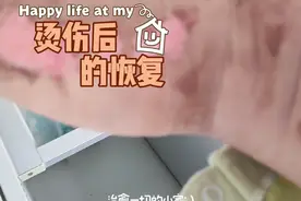 烫伤烧伤第一时间一定要冲冷水，最好冲够20-30分钟