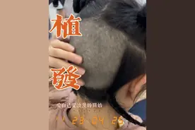秃头姐妹千万别做发际线！！！！因为……你们自己看吧！#拯救发际线 #植发后的真实记录 #秃头少女视频封面