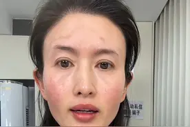 千万不要轻易的去斑，斑是去不掉的，我花了8100块钱，你们看一下就是这个样子，你们觉得值吗？尴尬期长达三个月之久，我怎么老是掉坑？去年搞个双眼皮儿，大家说也没搞好，垫个下巴把嘴垫歪了，取了硅胶假体，钱花了还白挨痛，现在下巴还松松垮垮，难道是我这个人好说话？#爱自己 #素颜#原相机视频封面