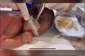 #桂林dou精彩 #医院 罕见！出生半个月蜕了一层皮。桂林火棉胶婴儿“金蝉脱壳”出院。视频封面