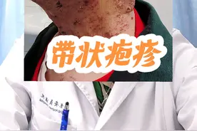 带状疱疹近期高发，注意不要过度疲劳，中老年可以接种疫苗预防带状疱疹#带状疱疹 #硬核健康科普行动 #年度健康知识干货