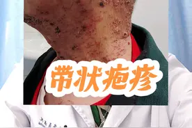带状疱疹近期高发，注意不要过度疲劳，中老年可以接种疫苗预防带状疱疹#带状疱疹 #硬核健康科普行动 #年度健康知识干货