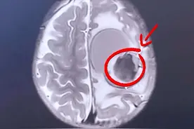 一岁多孩子，突然抽搐，单侧肢体活动异常，急诊CT发现颅内占位性病变，颅内出血，情况紧急！#血管瘤 #脑出血#儿童健康 #抽搐 #摔跤视频封面
