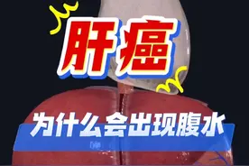 肝癌的病人为什么会出现腹水？ #肝癌 #腹水 #硬核科普健康行动 #抖出健康知识宝藏 #抖音创作季