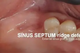 上额窦外提。专业视频，无不良引导。#医学科普视频封面