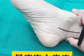 踝管综合征 踝管综合征，保守治疗效果不佳的情况下，需要考虑手术治疗。#踝管综合征视频封面