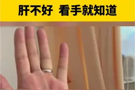 肝掌确实说明肝是有问题的！ 其实肝病方面的症状还是比较多的，肝掌是一个，也能比较明显的看出来，手掌两侧的大小鱼际和指尖会出现片状发红或者斑点、斑块，咱们用棉棒或者手指按压后会发白，松开后又呈现红色。 大家手上如果有这样的情况，最好抓紧先去检查一下肝功能，包括像蜘蛛痣、黄疸、肝区疼痛等等方面的一些症状，尤其是有基础肝病的朋友，如果频繁出现这些问题，一定要提高警惕！ #科普 #肝病 #肝硬化 #乙肝 #山东