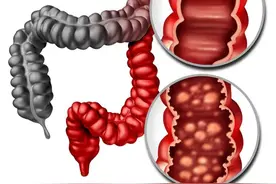 我的肠子为什么变黑了？关于结肠黑变病图片