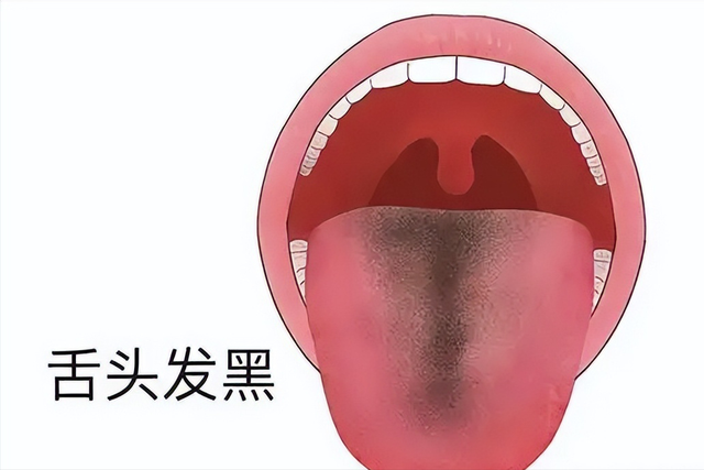 舌头出现这6个表现，说明体内有肿瘤！千万不要不当回事