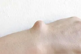 身上长了“脂肪瘤”，不痛不痒，需要治疗吗？医生：主要看这几点图片