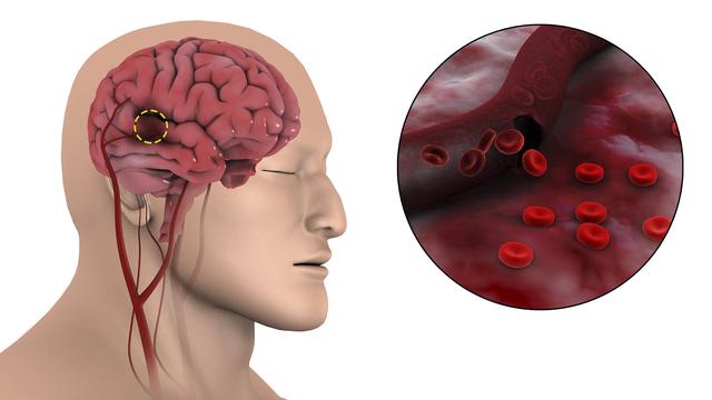 老年人出现脑萎缩怎么办？科学使用6种药物，积极改善大脑代谢