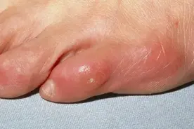 鸡眼形成的原因，总结治疗的方法图片