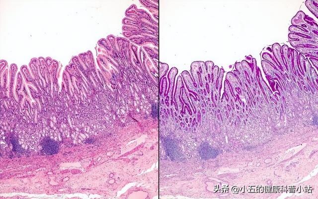 得了糜烂性胃炎怎么办？科学服用5种药物，有效保护和修复胃黏膜