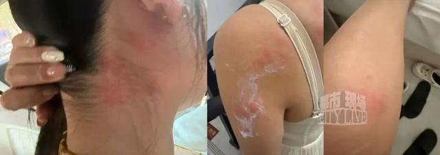 海南三亚天涯小镇一民宿惊现臭虫，一女子被咬后过敏	，全身起满红疙瘩，当地文旅部门介入