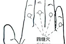 四缝穴，开胃穴！祛疳积的要穴图片