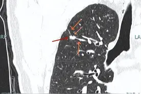 我们切了个良性肺结节！能从中得出什么经验教训，需要反思一下！图片