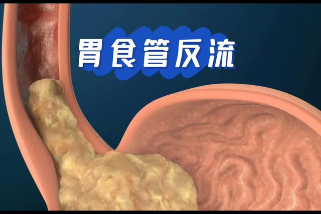 豆腐再次被关注！医生研究：胃酸反流患者常吃豆腐，或出现5改善