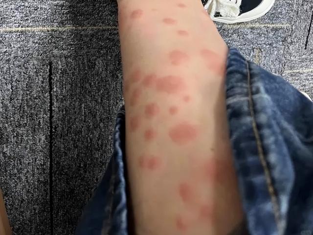 比蚊子还毒！被咬后奇痒无比，长时间难以消退！多人中招