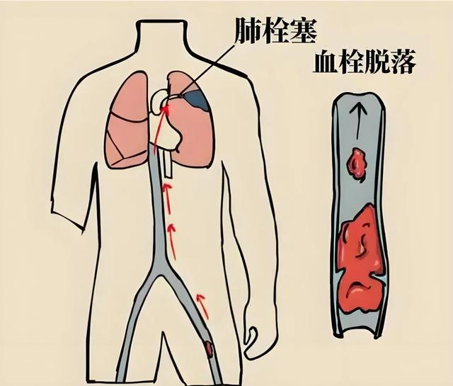 神经重症患者长期卧床,别忽视这个“沉默的血管杀手”!