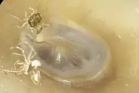 她耳朵里一直有声音，竟然是蜘蛛在里面爬，还蜕了皮！图片