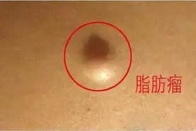 脂肪瘤越长越多，用二陈汤没用？试试这味便宜药，化痰更猛还散结图片