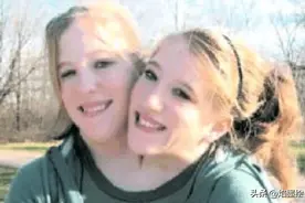 双头姐妹“怀孕”引热议，腰部以下器官共享，谁是孩子真实母亲？图片