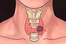 适合甲状腺结节患者食用的蔬菜和水果，以及相关的饮食建议图片
