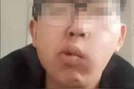 26岁帅小伙吃槟榔多年后眼歪嘴斜，当事人：找工作困难，望大家引以为戒图片