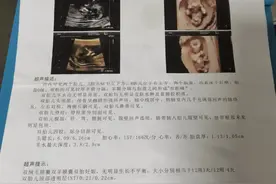 罕见 双胎竟然变成了单胎图片